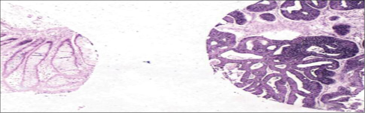 Differential expression of miR-21 in colon cancer versus the adjacent normal tissue. In situ                            hybridization analysis for miR-21 in this core tissue microarray sample showed very high expression in the cytoplasm of cancer dells (right part of the image) and very low expression in the adjacent normal colonic tissue epithelia (left part of image). The signal is blue due to nitroblue tetrazolium and bromochlorindol phosphate and counterstaining with nuclear fast red, x10 67.