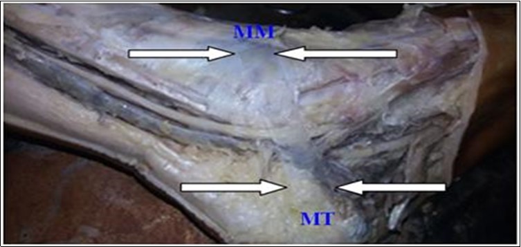 Medio Malleolar Calcaneal axis‟ (MMC axis) made by transparent plastic sheet in the left foot, (MM): Medial Malleolus, (C): Medial tubercle of calcaneus.