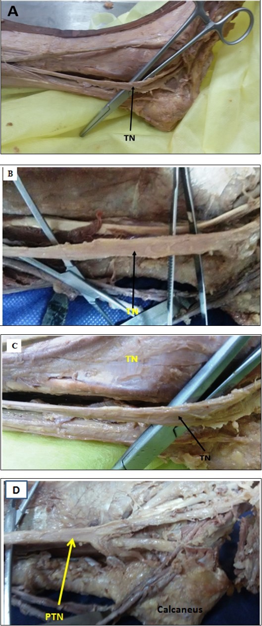A, B, C, and D showing the flattened shape of the PTN in tarsal tunnel PTN= Posterior Tibial nerve