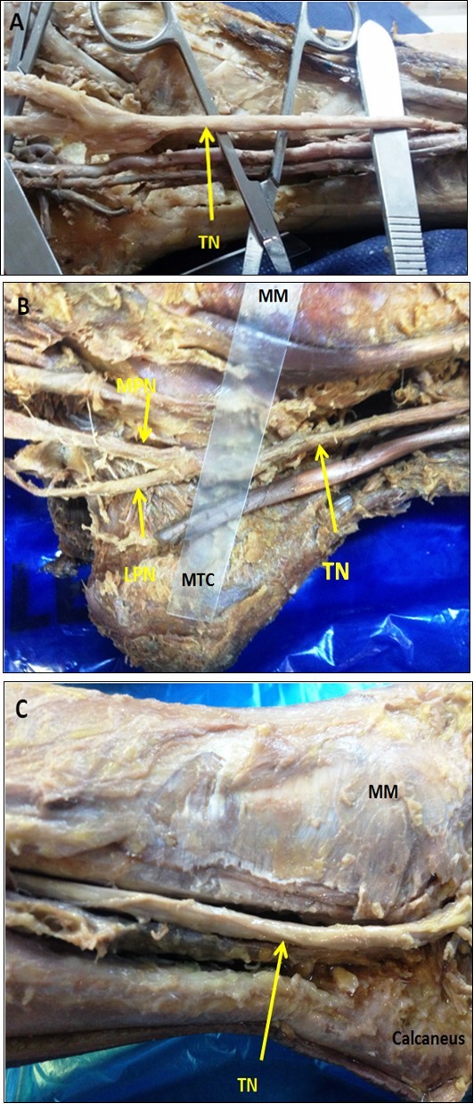 (A), (B) & (C) showing rounded shape of the PTN.