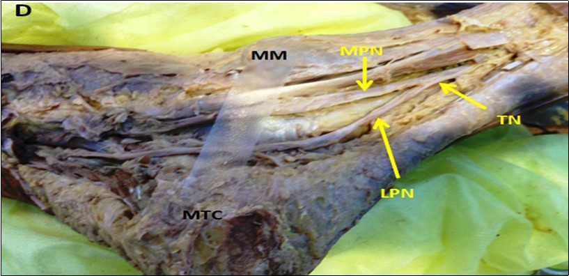 Showing PTN divided into Medial and lateral planter nerves outside tarsal tunnel (type I TN).
