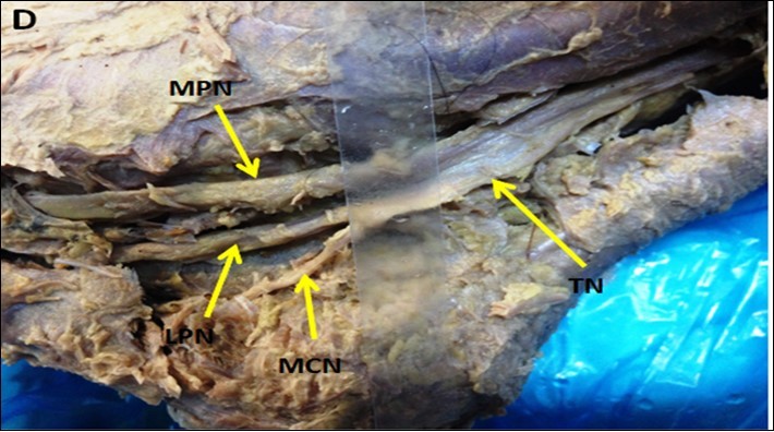 showing PTN bifurcates inside the tarsal tunnel (Type II PTN)
