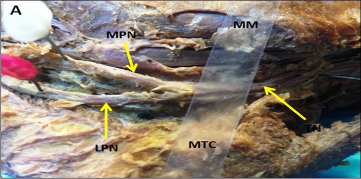 Showing PTN bifurcates distal to the MMCA                         (Type III TN)