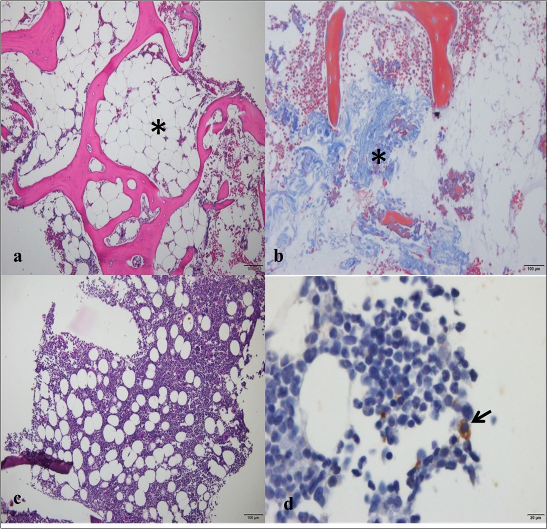 Photomicrographs of the bone marrow of a female dog with a mammary tumor. a) Note severe hypocellularity and predominance of adipose tissue (*), in a female dog positive for Ehrlichia canis                   (bar = 100 µm; hematoxylin and eosin). b) Note the proliferation of fibrous tissue (*) in the bone marrow (bar = 100 µm; Masson’s trichrome). c) Note the normocellular bone marrow in the analysis on the biopsy (bar = 100 µm; hematoxylin and eosin). d) Same animal as in C, showing an epithelial cell positive for                   cytokeratin-19 (arrow; bar = 20 µm; peroxidase-linked polymer complex).