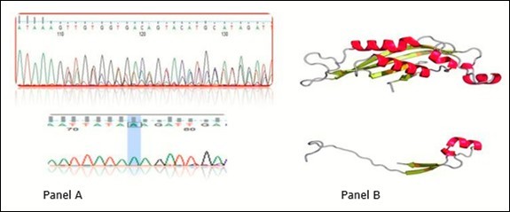 Chromatogram of novel deletion mutation. The upper part of panel A is wild type             sequence and the lower part is the truncated mutant PTPS gene. Panel B is the 3D protein structure of PTPS in wild type and mutant one in upper and lower respectively.