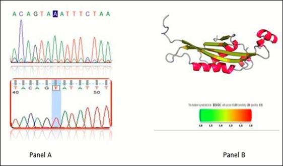 Chromatogram of novel mutations. Panel A sequence analysis of A>T 86 mutation in the lower part of panel A to compare with wild type sequence in the upper part. 3D             structure of mutated protein in upper region and pathogenicity of the mutation by polyphen2. The probability is benign with score of 0.001 (sensitivity 0.99 and specificity 0.95)