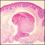 Papillary endothelial hyperplasia exemplifying papillary configuration with endothelial cell layering and a superimposed stratified squamous epithelial       lining 12.