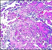 Papillary endothelial  hyperplasia enunciating papillary arrangements coated with single layer of endothelial cells                      intermingled with  significant fibrinous and thrombotic exudate13.