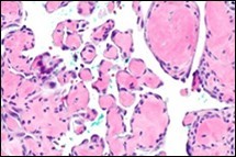 Papillary endothelial hyperplasia             exhibiting papillary configurations lined with            single endothelial cell layer and lack of                  significant atypia 14.