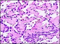 Papillary endothelial hyperplasia delineating  papillary articulations layered with a single endothelial cell layer and an admixed fibrinous exudate 15.