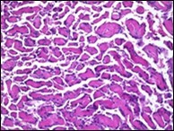 Papillary endothelial                      hyperplasia demonstrating significant papillary architecture, a single lining of endothelial cells intermixed with            fibrinous and thrombotic substances and lack of atypia 16.