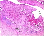 Papillary endothelial          hyperplasia depicting papillae        layered with a single endothelial layer, absence of atypia and               fibrinous, thrombotic material 17.