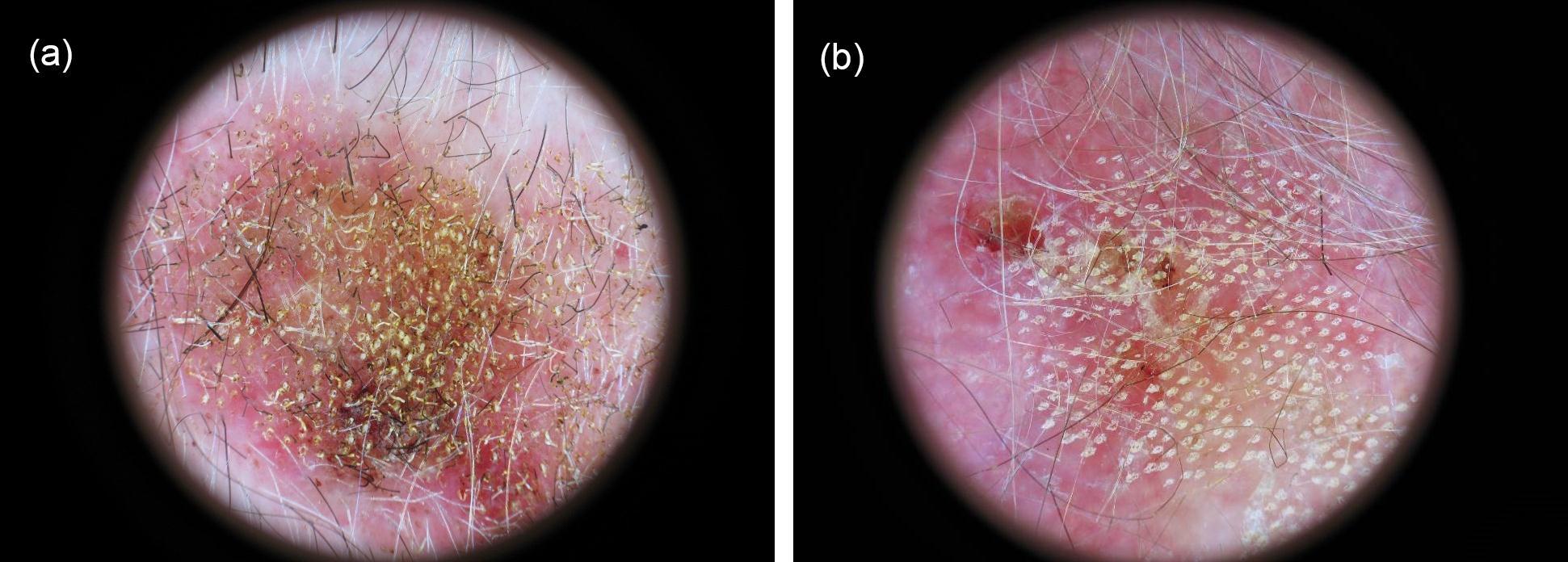 Dermoscopic pictures of two microporated and imiquimod treated lesions: a) Arm 4 basal cell carcinoma showing an initial erythema at day 2. Microporation was performed with 1 shot at 10 pulses. b) Arm 2 actinic keratosis showing erythema, crusting and erosions at day 11. Microporation was performed with 2 shots at 3 pulses.