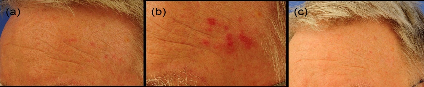 Long-term follow up of an actinic keratosis patient. a) Initial situation, b) day 20 at the end of the study, c) 6 month later. Notably, no relapse.