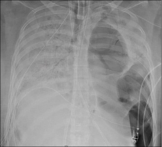 An X-ray of the patient’s lungs before              surgery. Northwestern Medicine