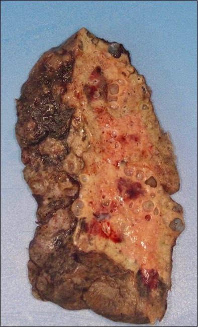 Damaged lung removed       following transplantation. Northwestern Medicine