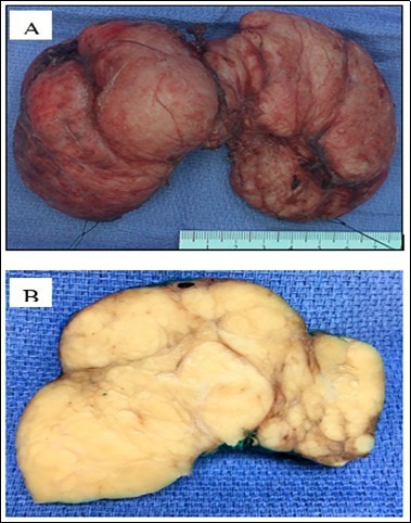 Gross examination of the thyroidectomy specimen shows a diffusely enlarged thyroid gland with bilateral bulging nodules (A, picture taken before fixation). A cut section shows the thyroid gland is replaced by innumerable yellow tan solid nodules of                 variable sizes surrounded by fibrous bands (B, picture taken after     fixation).