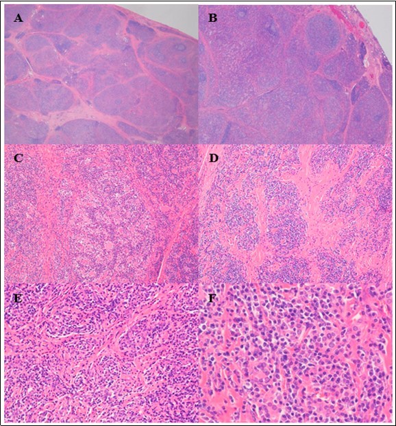 Representative photomicrographs of the thyroidectomy specimen. Scanning power view shows many nodules separated by fibrous bands (A). There were a few scattered small foci of           lymphocytic infiltrate with lymphoid follicle and germinal center formation, suggestive of Hashimoto’s thyroiditis (B). Low to medium power view showing a dense plasmacytic infiltrate with remnant atrophic thyroid follicles visible in some nodules (C), while in other nodules the thyroid parenchyma is almost entirely replaced by sheets of plasma cells (D, E). At high power, the plasma cells are              well–differentiated; they have eccentrically-located nuclei, clock-face chromatin, inconspicuous                nucleoli, and abundant cytoplasm (F). (H&E stain; original magnification, x 10 A, x 20 B, x 100 C and D, x 200 E, and x 400 F).