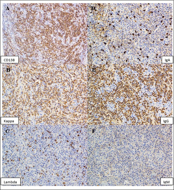 A panel of immunohistochemical stains show the plasma cells are positive for CD138 (A). The majority of the plasma cells are positive for kappa light chain (B) and IgG heavy chain (E). Only small subsets of plasma cells are positive for lambda light chain (C), IgA (D), or IgM (F). (Immunoperoxidase staining; original magnification, x 100 A, x 200 B).
