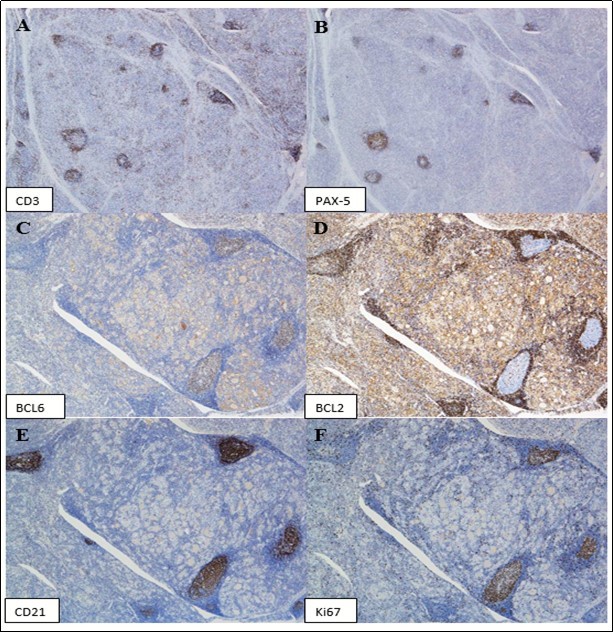Immunohistochemical stains show the lymphocytes are predominantly T-cells (CD3 positive, A), with the lymphoid follicles highlighted by PAX-5 stain (B). The germinal centers are positive for BCL6 (C) and negative for BCL2 (D). CD21 stain highlights undisrupted follicular dendritic cell      meshworks (E). Ki67 stain shows appropriately high proliferation rates in germinal centers with              polarization. (Immunoperoxidase staining; original magnification, x 20 A and B, x 40 C).