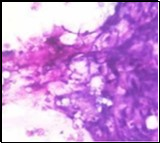 Parachordoma on fine                needle aspiration cytology depicting clusters of spheroidal cells with               eosinophilic cytoplasm, regular nuclei and clumped, encompassing myxoid stroma 13.