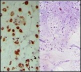 Parachordoma delineating clusters of vacuolated, spherical cells with acidophilic cytoplasm, uniform nuclei and an immune non reactive  CD34- 13.