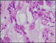 Parachordoma exemplifying clusters and nests of spherical,              vacuolated cells with abundant,               acidophilic cytoplasm, regular nuclei and an enveloping cartilaginous              stroma 14.