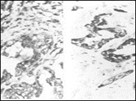 Parachordoma depicting cords and aggregates of vacuolated cells with acidophilic cytoplasm and regular, miniature nuclei with an          encompassing myxoid stroma 15.