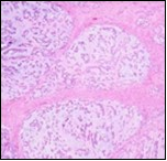Parachordoma exhibiting nests and clusters of spheroidal cells with eosinophilic, vacuolated                   cytoplasm, uniform, bland nuclei and a circumscribing myxoid stroma 15.