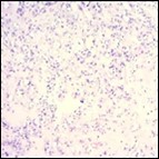 Parachordoma delineating clusters and nests of spindle-shaped and spherical, vacuolated cells with eosinophilic cytoplasm and uniform nuclei 16.