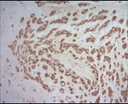 Parachordoma depicting               immune reactivity to S100 protein 16.