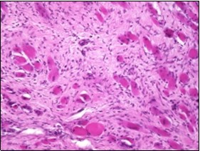 Fibromatosis colli depicting              bundles of fibroblasts and myo-fibroblasts intermixed with a collagenous stroma and entrapped  myocytes 9.