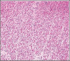 Fibromatosis colli  depicting   fascicles of fibroblasts and myo-fibroblasts admixed with a collagenous stroma and  extravasation of numerous  red blood        cells 10.