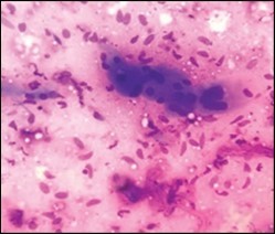 Fine needle aspiration                cytology of fibromatosis colli delineating                   aggregates of plump, spindle-shaped cells admixed with fibroblasts, fibro-connective tissue fragments and intermingled red cell extravasation 11