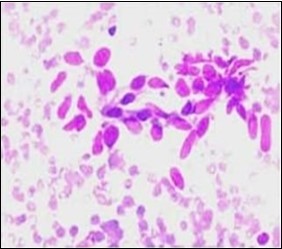 Fine needle aspiration  cytology of                     fibromatosis colli exhibiting aggregates of spindle- shaped cells, plump fibroblasts,                fibro-connective tissue fragments  and a   clear background with minimal red cell             extravasation 12.
