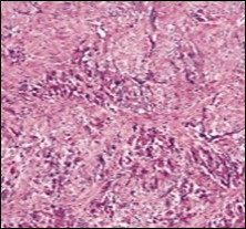 Fibromatosis colli depicting              clusters of spindle-shaped cells, plump fibroblasts and comingled mature skeletal muscle fibres with collagen-rich                 stroma 13.