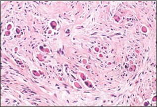 Fibromatosis colli exhibiting                fibroblasts, myo-fibroblasts and an abundant collagenous stroma with commixture of              enlarged myocytes 14.