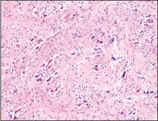 Fibromatosis colli  enunciating fibroblasts, myo-fibroblasts and                      collagenous stroma with dispersed               mature myocytes 14.