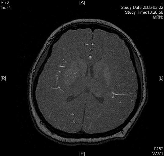 Lesion in the right basal ganglia displayed in the source image of MRA
