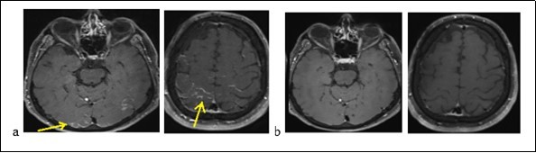 Brain MRI displaying occipital cortical hypersignals in Flair sequences (a) and decrease of lesions (b)