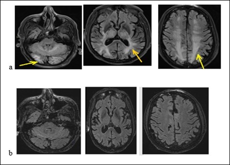 Brain MRI with flair sequences showing hyper signals of white              matter and cerebellum corresponding to edema (a) and the decrease of              lesions after treatment (b).