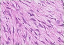 Low grade fibromyxoid sarcoma enunciating fibrous and myxoid zones of               uniform spindle-shaped tumour cells with     absence of atypia 9.