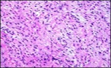 Low grade fibromyxoid sarcoma                exemplifying intermingled foci of fibrous and             myxoid regions of spindle-shaped cells with            minimal pleomorphism and absence of mitosis (10).