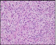 Low grade fibromyxoid sarcoma demonstrating alternating fibrous and myxoid areas comprised of uniform  spindle-shaped cells (11).