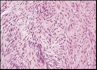 Low grade fibromyxoid sarcoma composed of alternating foci of fibrous and myxoid region with interwoven fascicles and bland spindle-shaped     tumour cells (12).