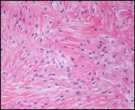 Low grade fibromyxoid sarcoma                   exhibiting alternating fibrous and myxoid zones composed of spindle-shaped tumour cells (13).