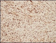 Low grade fibromyxoid sarcoma immune               reactive to MUC4(14).