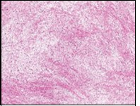 Low grade fibromyxoid sarcoma                 depicting alternating fibrous and myxoid regions with bland, spindle-shaped tumour cells and  absent mitosis (15).