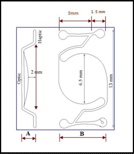 Intraocular lens design, with posterior chamber optic and angle-supported haptics.  Lateral view (A) and anterior view (B) with different IOL dimensions.