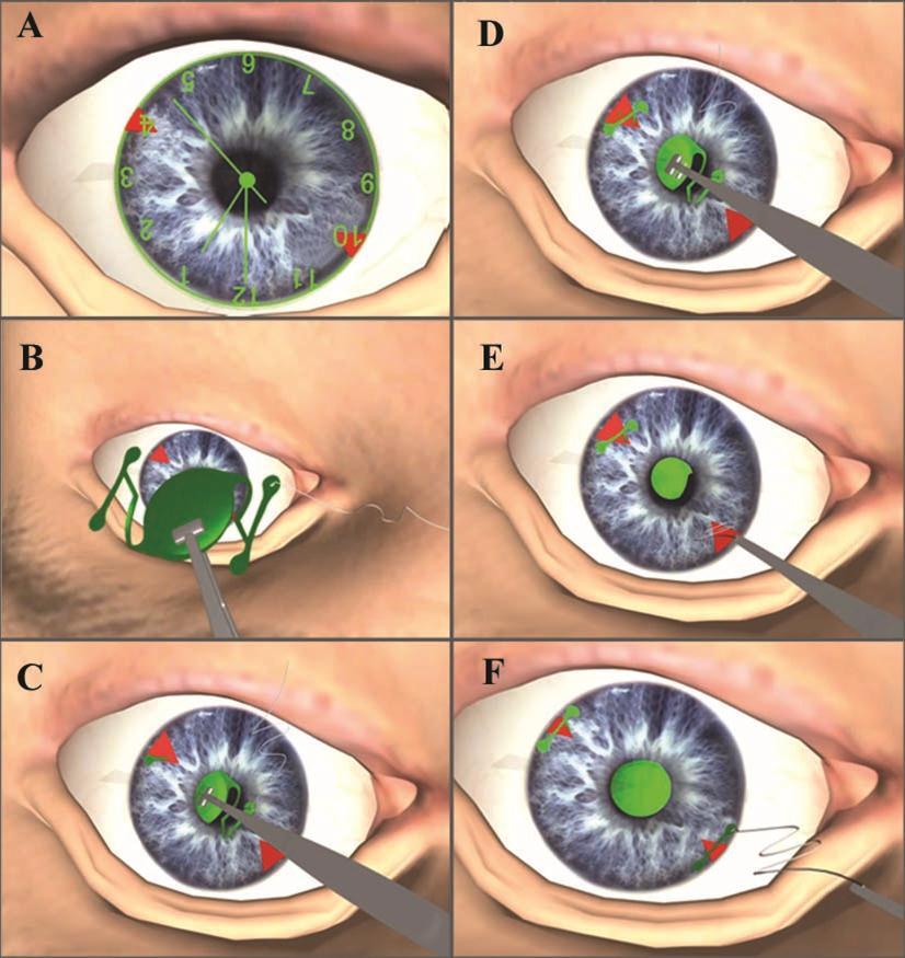 Operative steps. A- Two peripheral iridectomies at the 4 and 10 o’clock positions. B- Intraocular lens outside the eye with 10 nylon suture attached to the trailing haptic. C- The leading haptic passing through the pupillary area and appearing at the peripheral iridectomy at the 4 o’clock position. D- The broad end and the small end of the leading haptic appeared in the anterior chamber at the 4 o’clock position. E- The needle of the 10 /0 nylon suture that was tied to the trailing haptic passing through the pupillary area and passing through the peripheral iridectomy at the 10 o’clock position. The suture was then dragged away until the trailing haptic appeared in the anterior chamber. F- The broad end and the small end of the trailing haptic appeared in the anterior chamber at the 10 o’clock position.